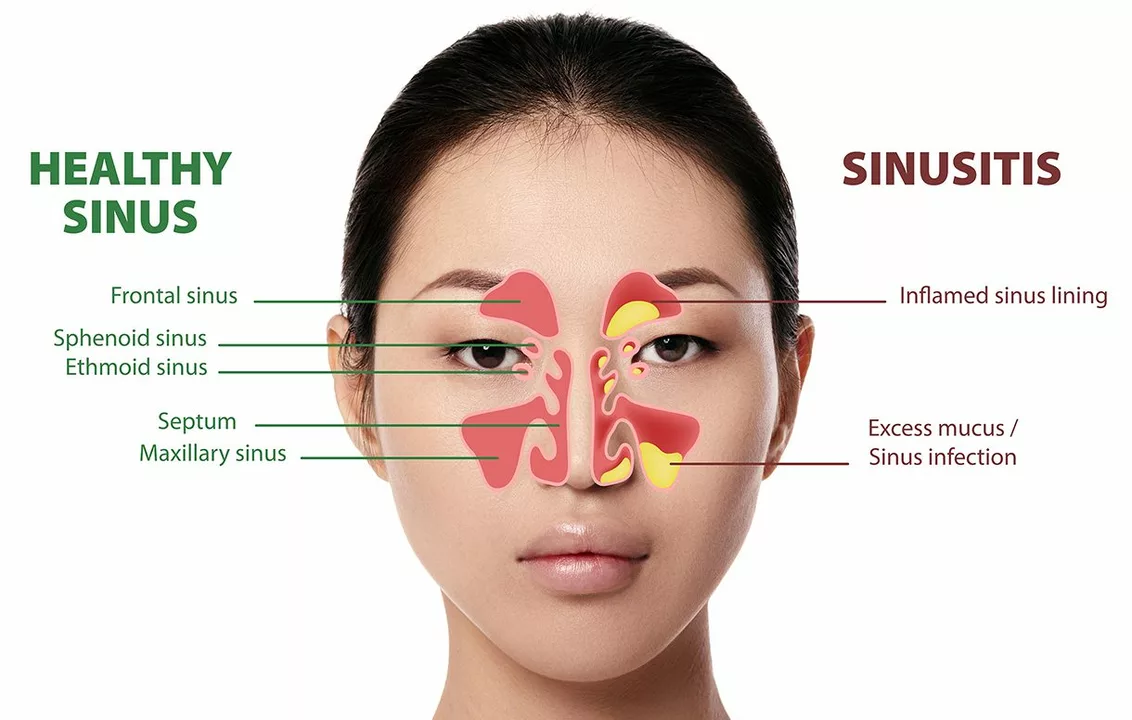The relationship between sinus infections and a runny nose