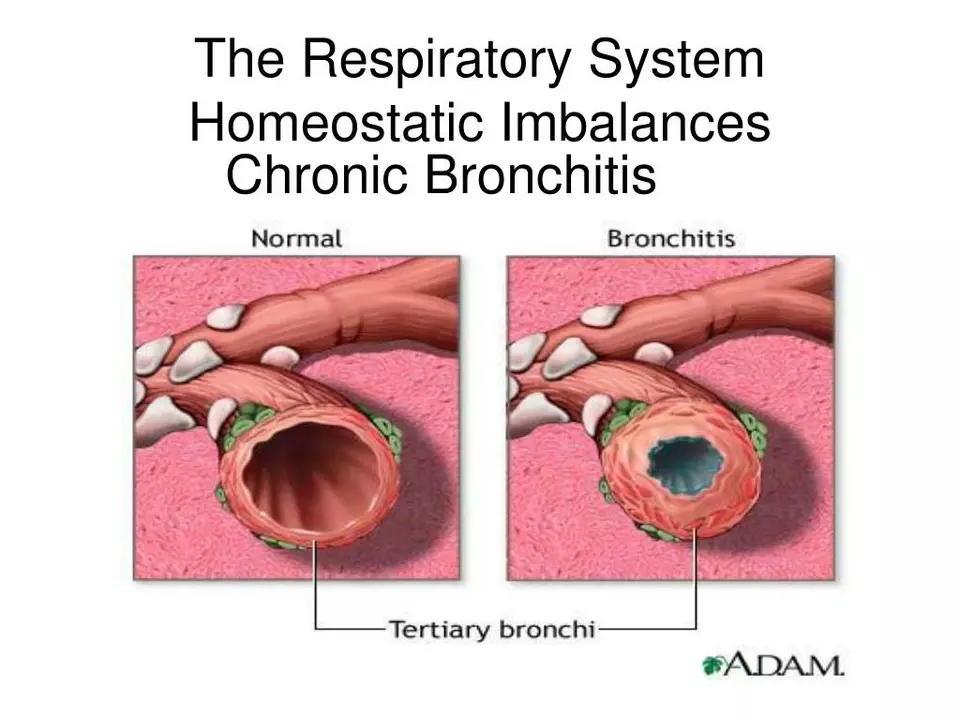 The Role of Bromhexine in Managing Chronic Bronchitis